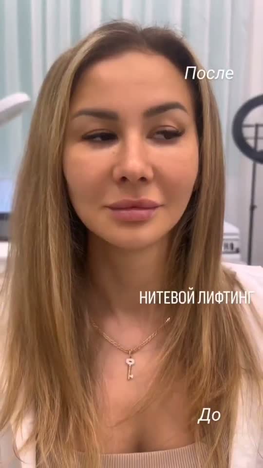 Нитевой лифтинг — результат до и после
