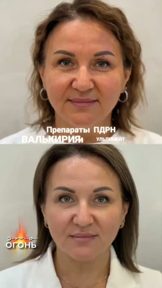 PDRN Ultimate — результат до и после