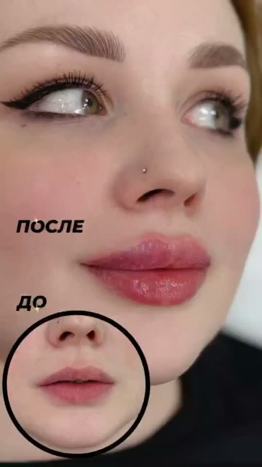 Контурная пластика губ — результат до и после