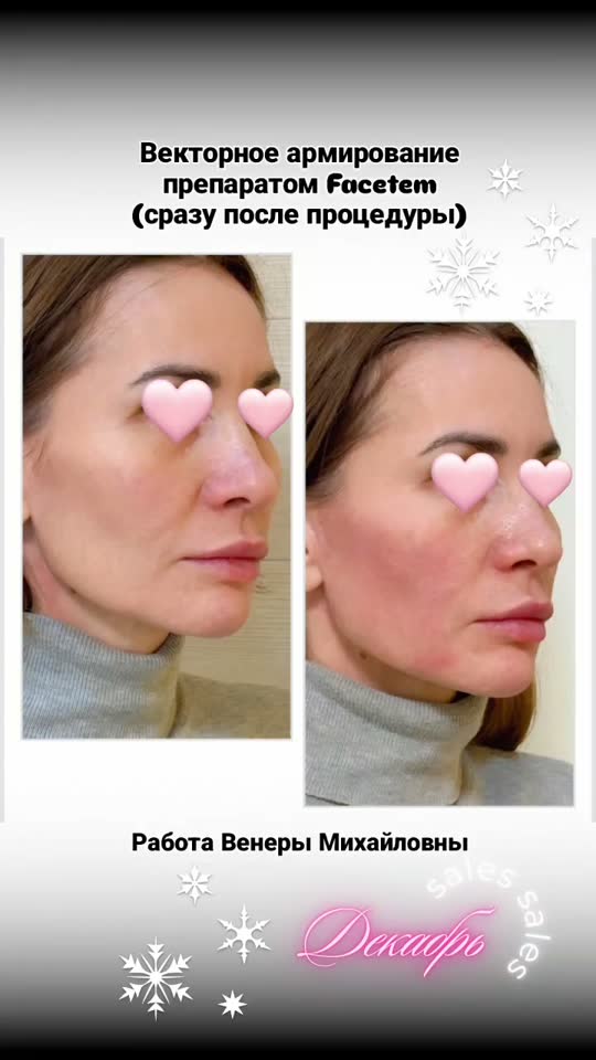 Векторное армирование Facetem — результат до и после