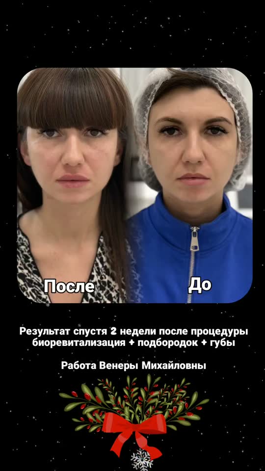 Биоревитализация, коррекция подбородка, губы — результат до и после
