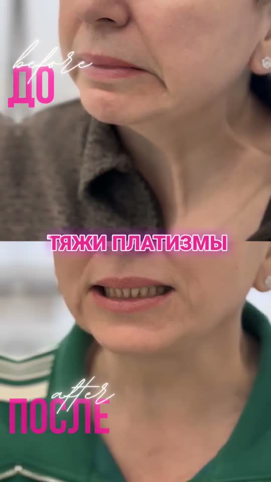 Тяжи платизмы — результат до и после