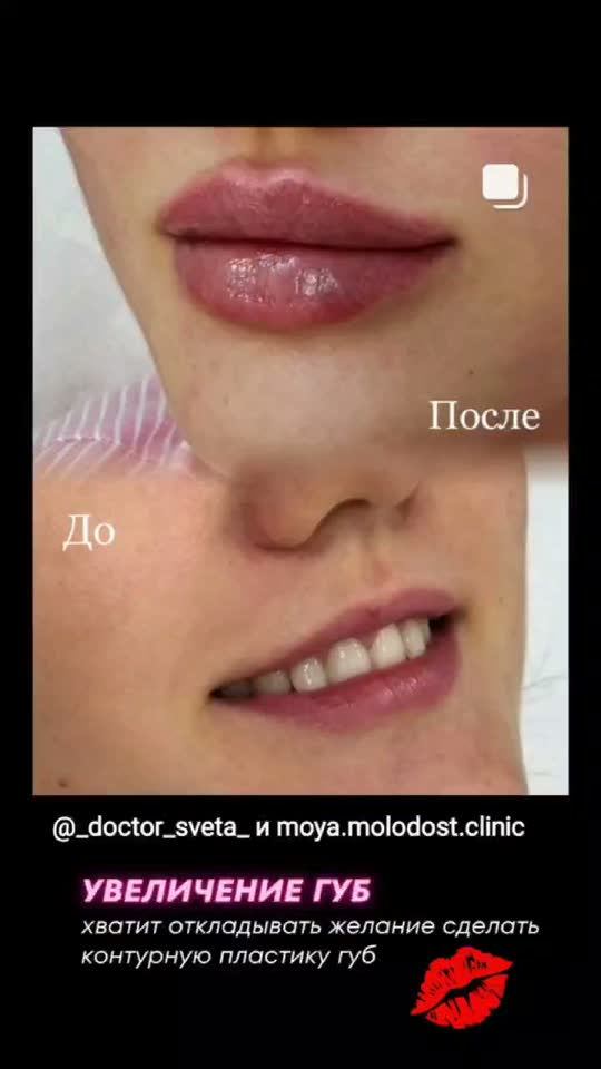 Увеличение губ — результат до и после