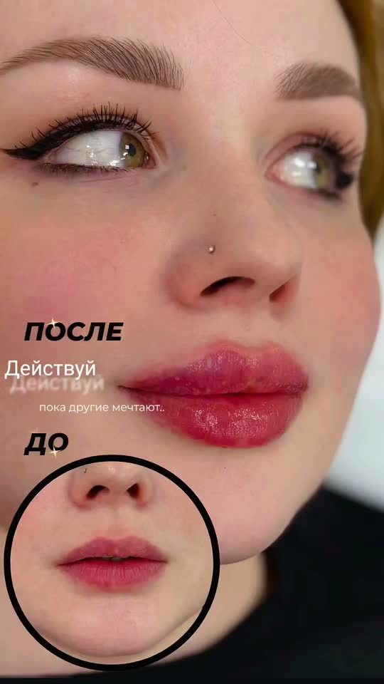 Контурная пластика губ — результат до и после