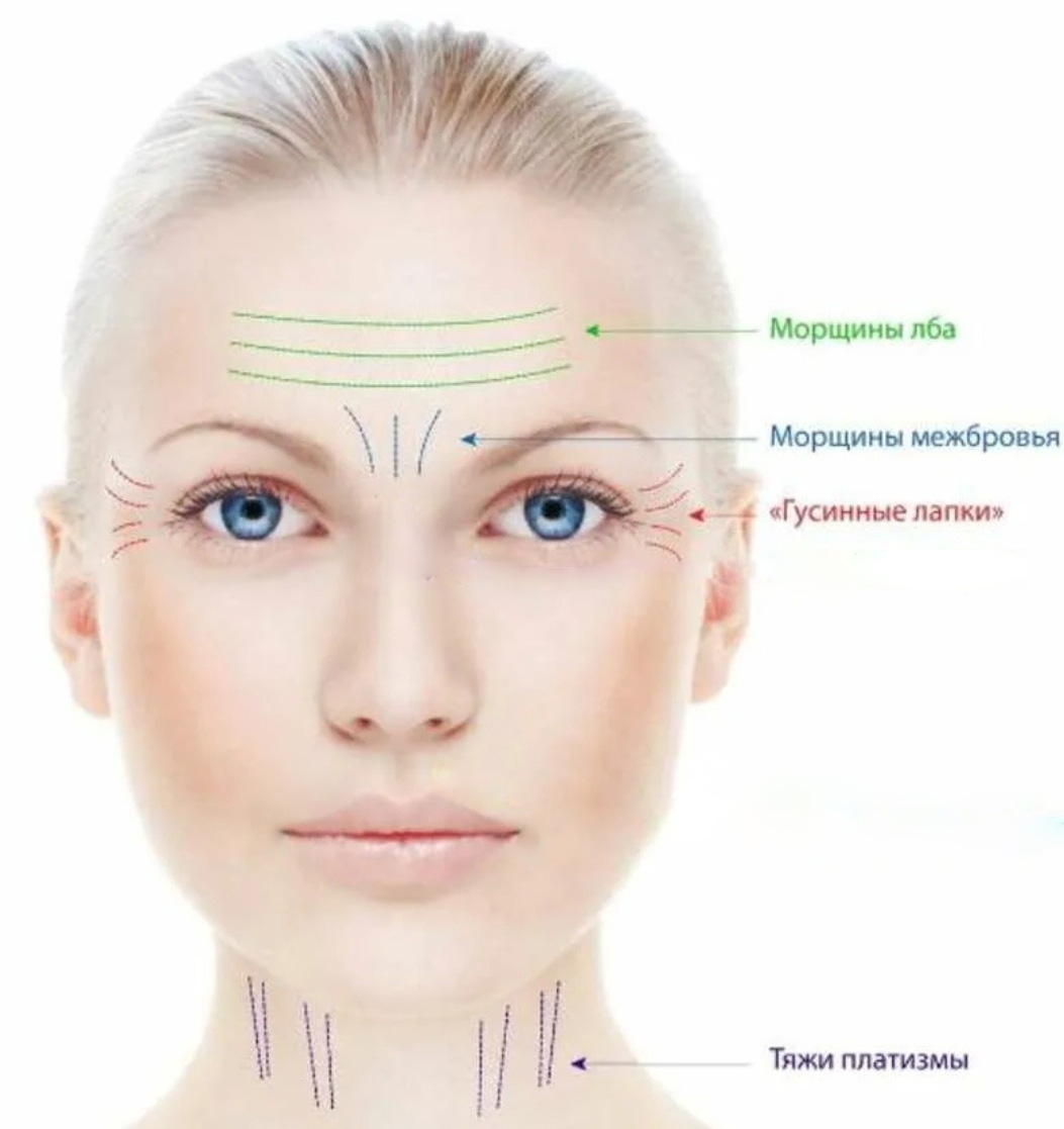 Botox/Диспорт/Xeomin/Релатокс Ботулинотерапия верхней трети лица + тяжи платизмы «под ключ» — Ботулинотерапия в Казани